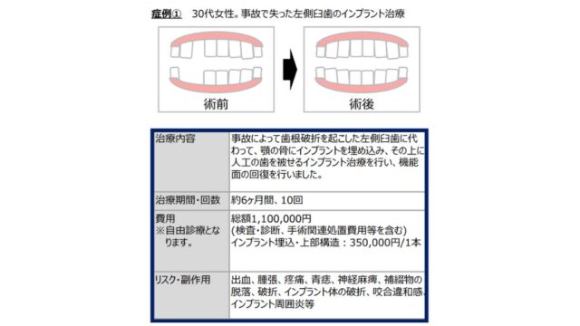 インプラント